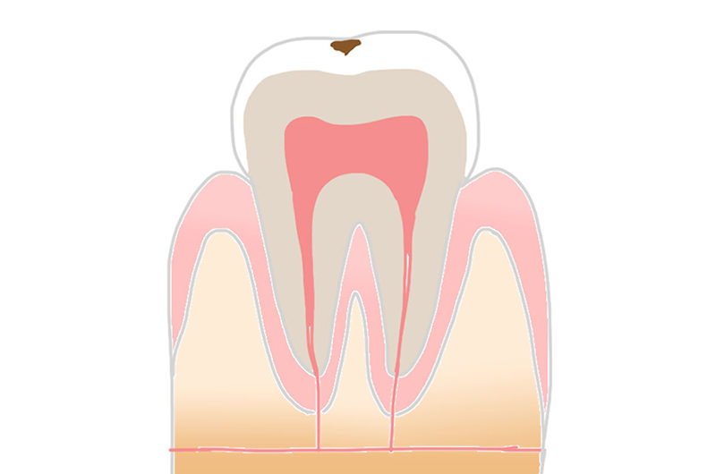 C1（エナメル質の虫歯）