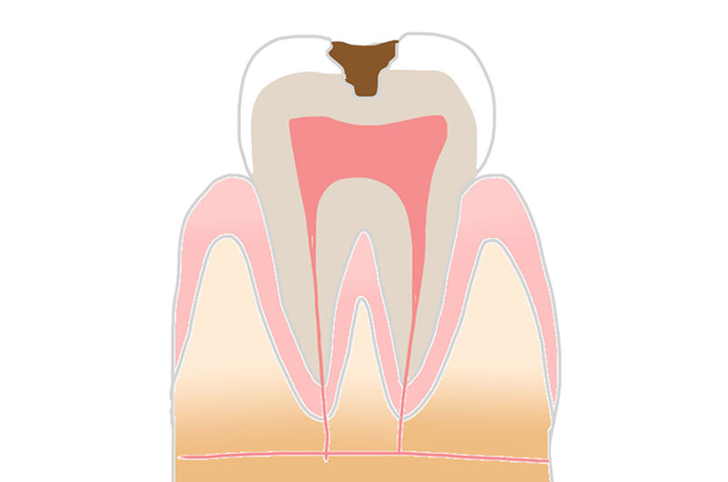 C2（象牙質の虫歯）