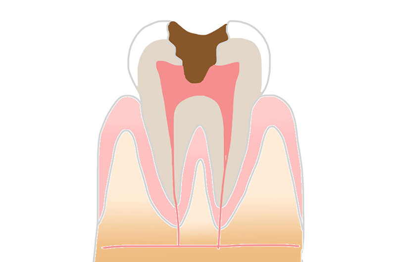 C3（神経まで達した虫歯）