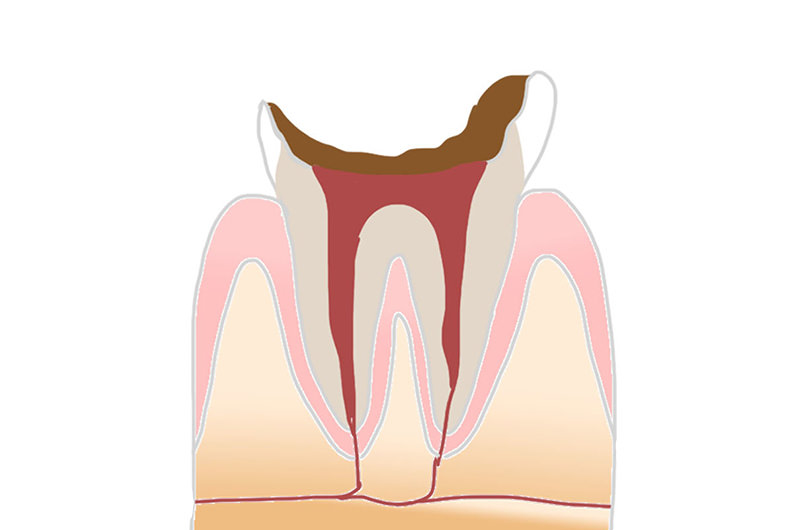 C4（歯根まで達した虫歯）