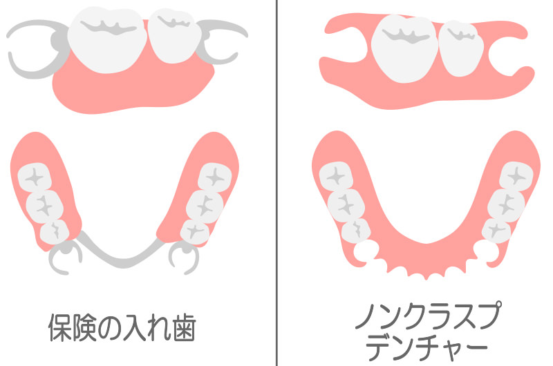 “留め具がない”“目立たない”部分入れ歯