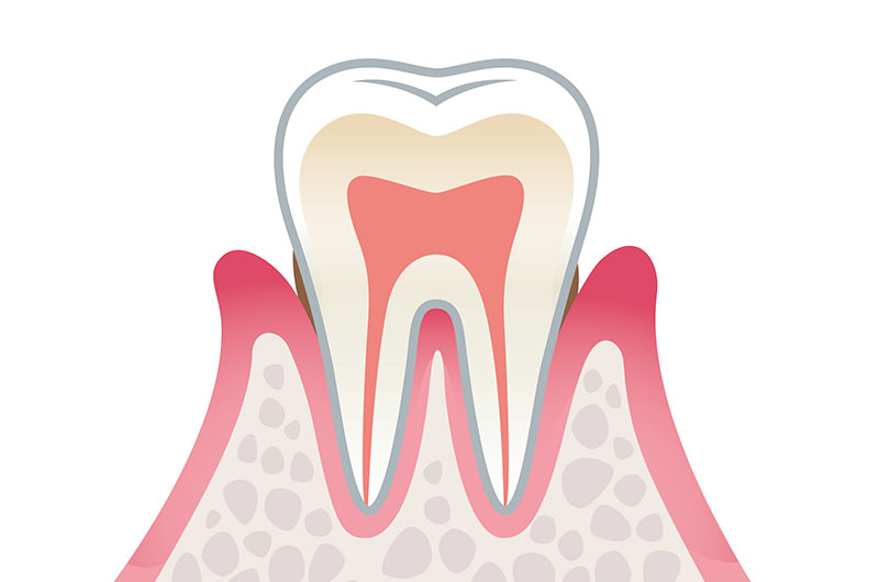 歯肉炎（軽度）