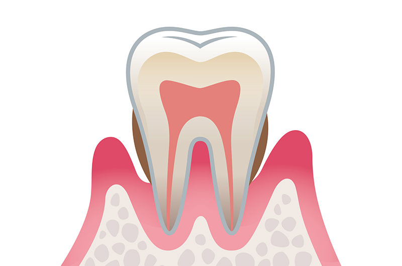 歯周炎（中等度）
